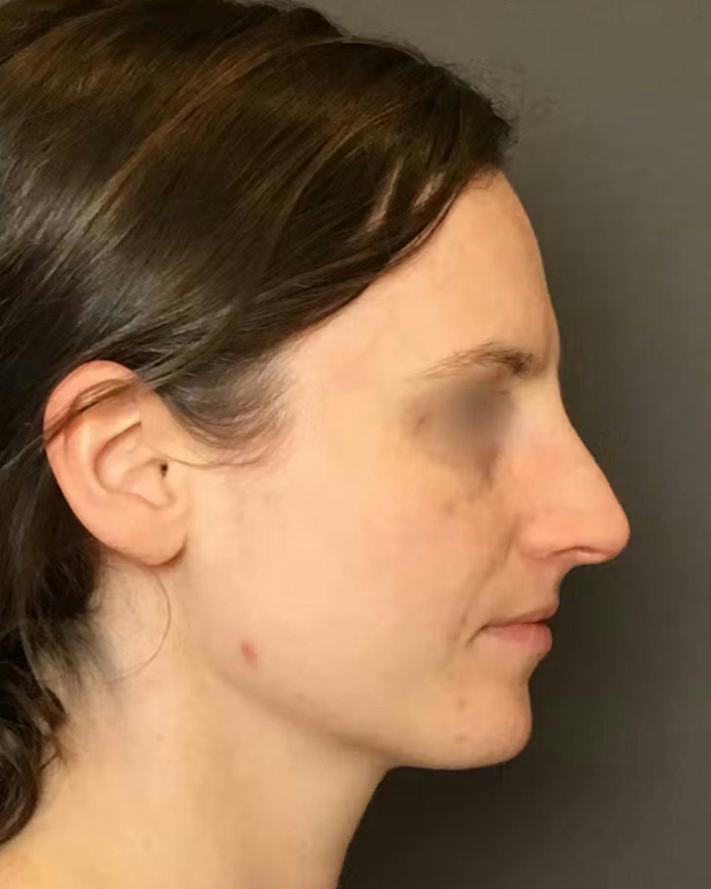 Rhinoplasty Before & After Gallery - Patient 172023 - Image 1