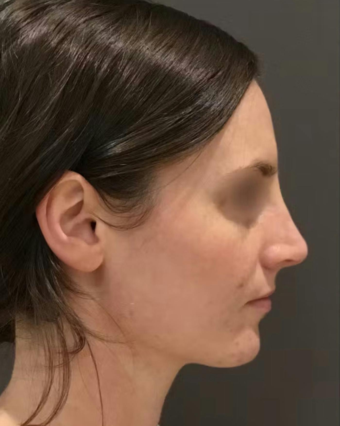 Rhinoplasty Before & After Gallery - Patient 172023 - Image 2