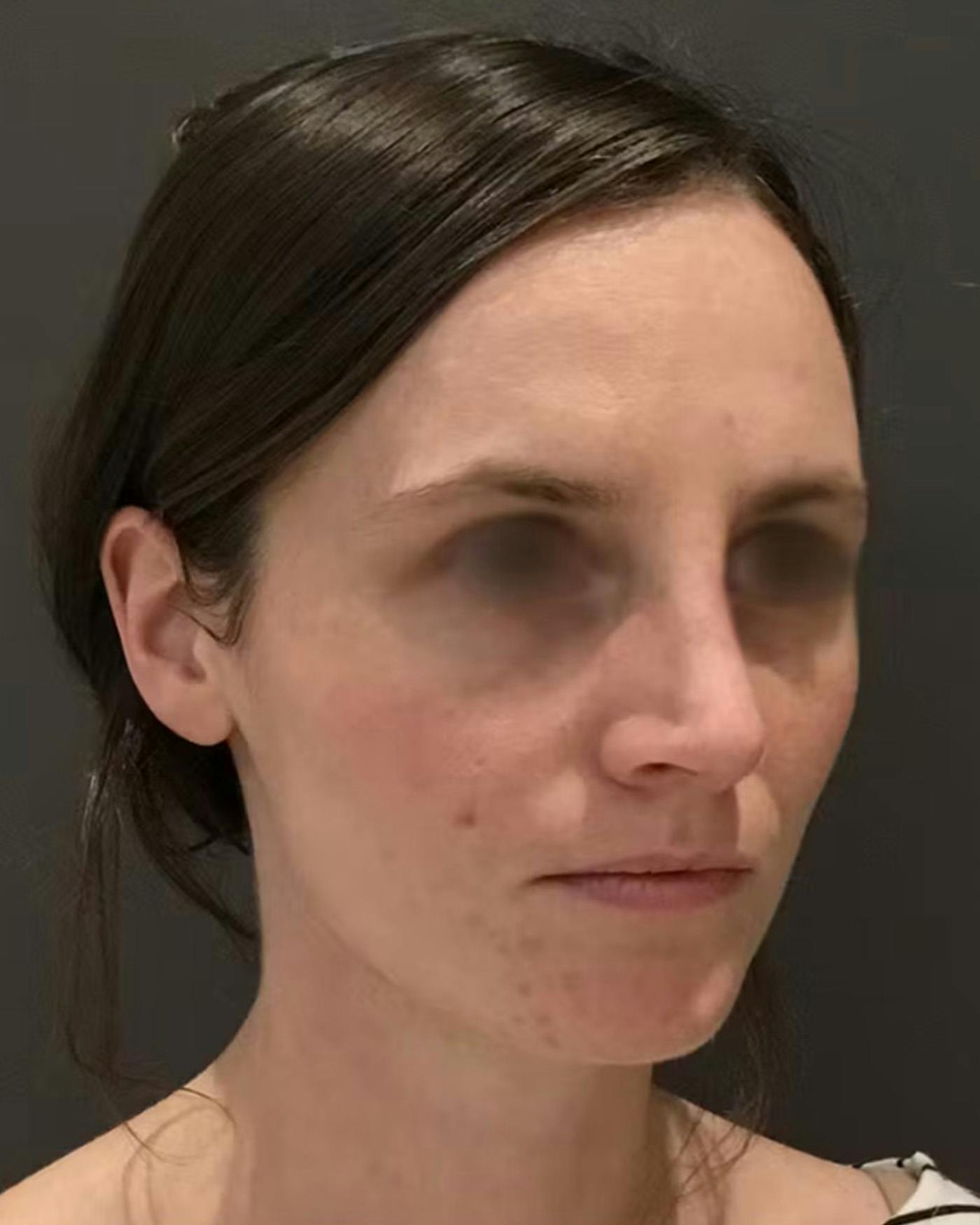 Rhinoplasty Before & After Gallery - Patient 172023 - Image 4