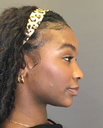 Rhinoplasty Before & After Gallery - Patient 297780 - Image 1