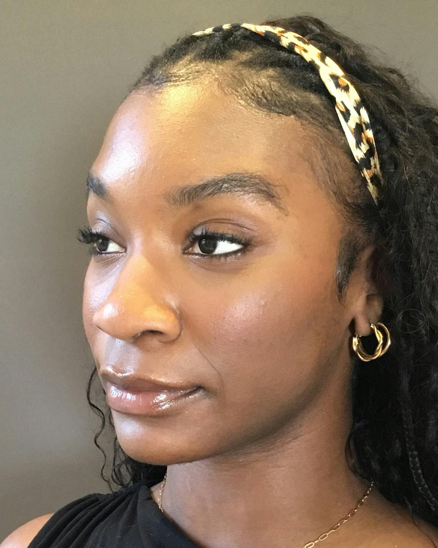 Rhinoplasty Before & After Gallery - Patient 297780 - Image 7