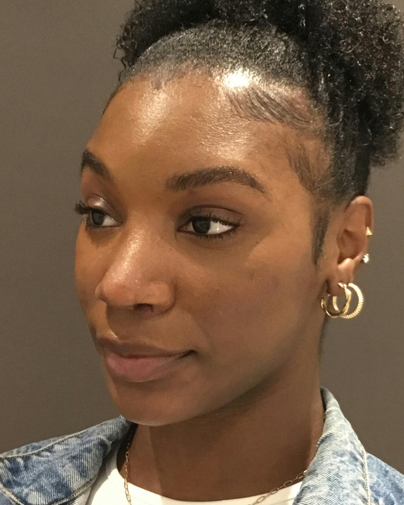 Rhinoplasty Before & After Gallery - Patient 297780 - Image 8