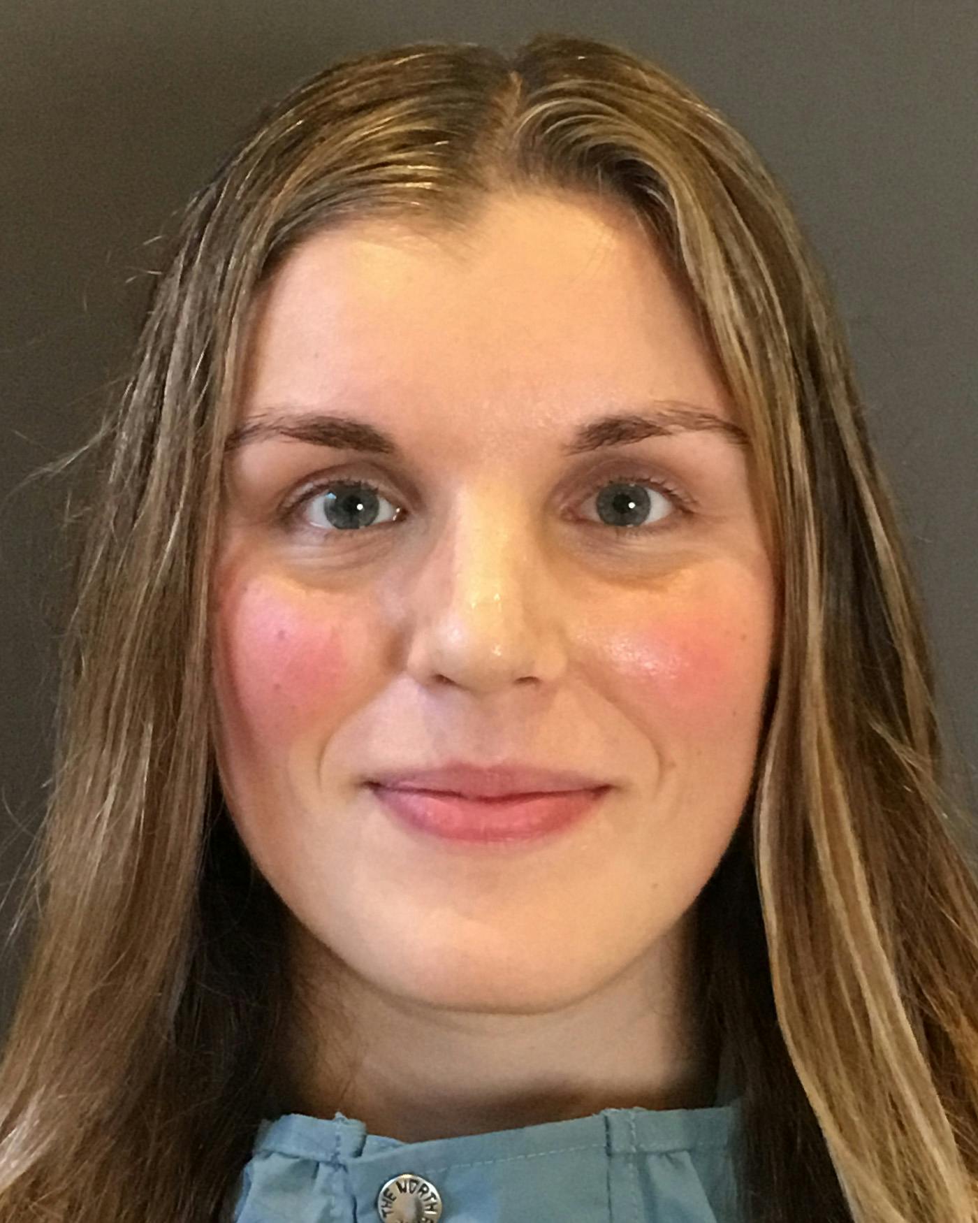 Rhinoplasty Before & After Gallery - Patient 360965 - Image 6