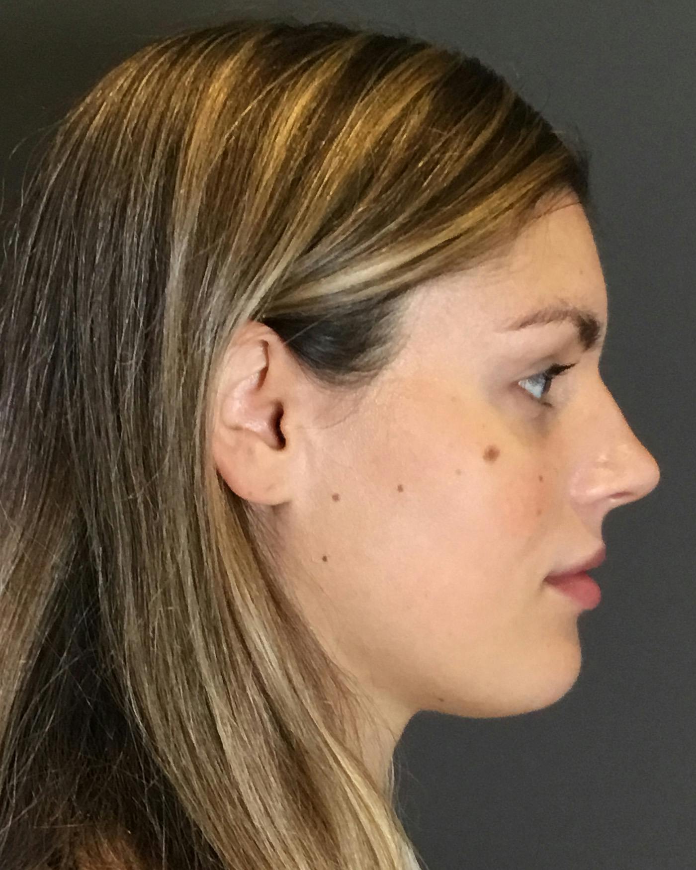 Rhinoplasty Before & After Gallery - Patient 360965 - Image 1