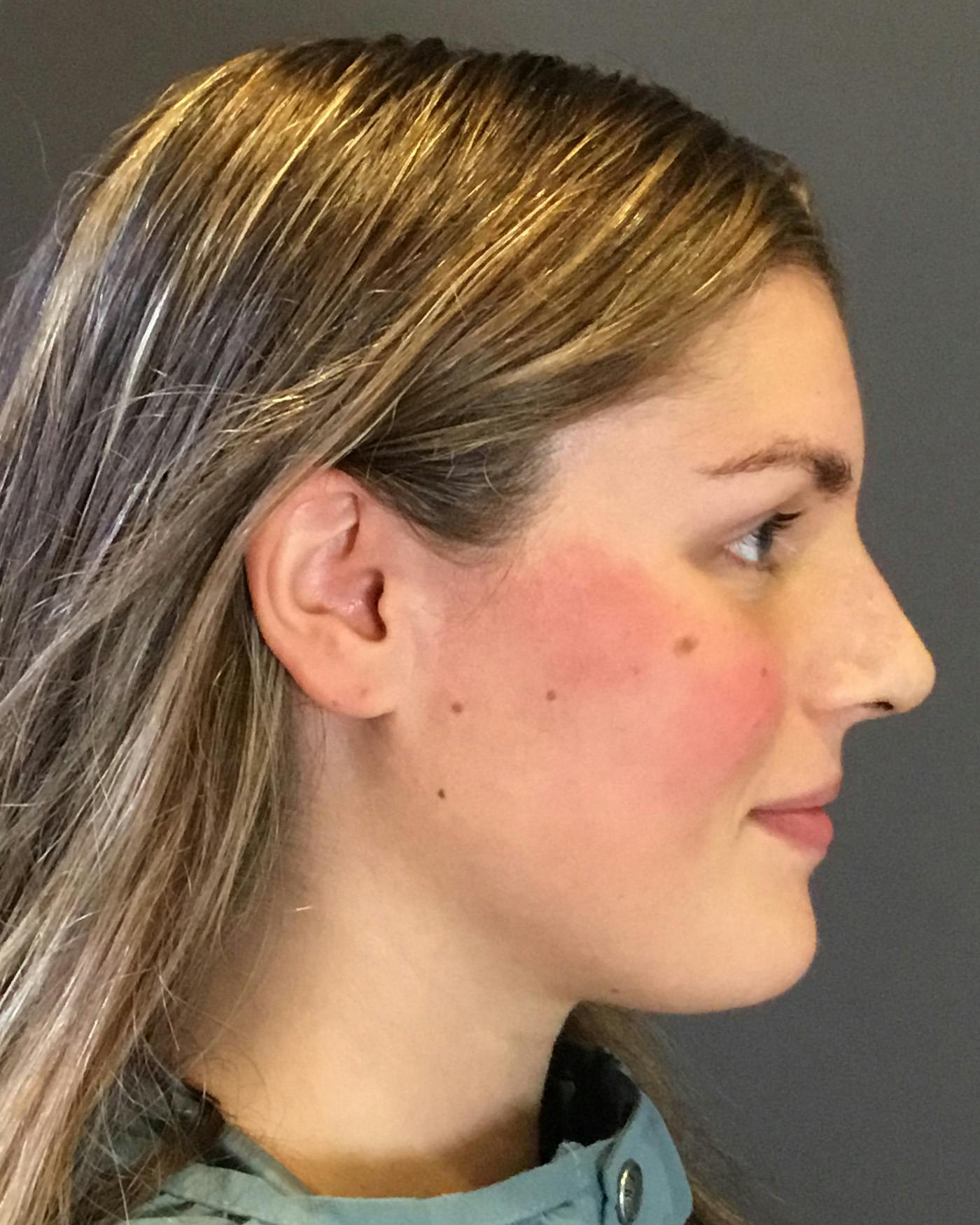 Rhinoplasty Before & After Gallery - Patient 360965 - Image 2
