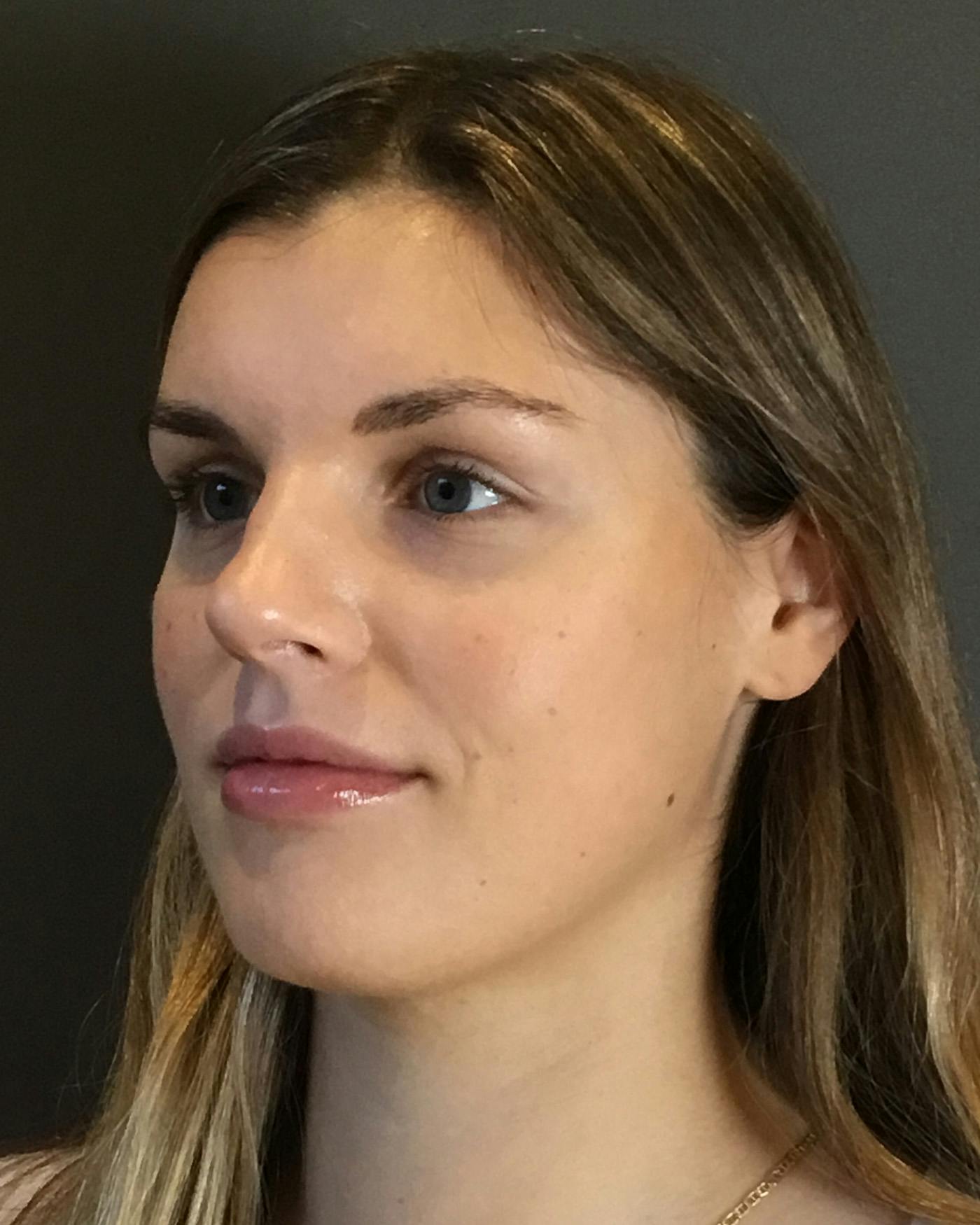 Rhinoplasty Before & After Gallery - Patient 360965 - Image 7