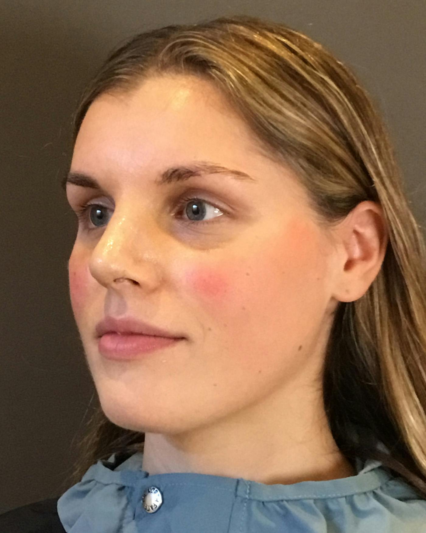 Rhinoplasty Before & After Gallery - Patient 360965 - Image 8
