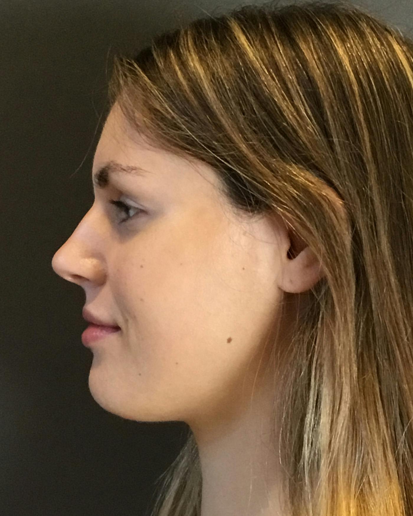 Rhinoplasty Before & After Gallery - Patient 360965 - Image 9