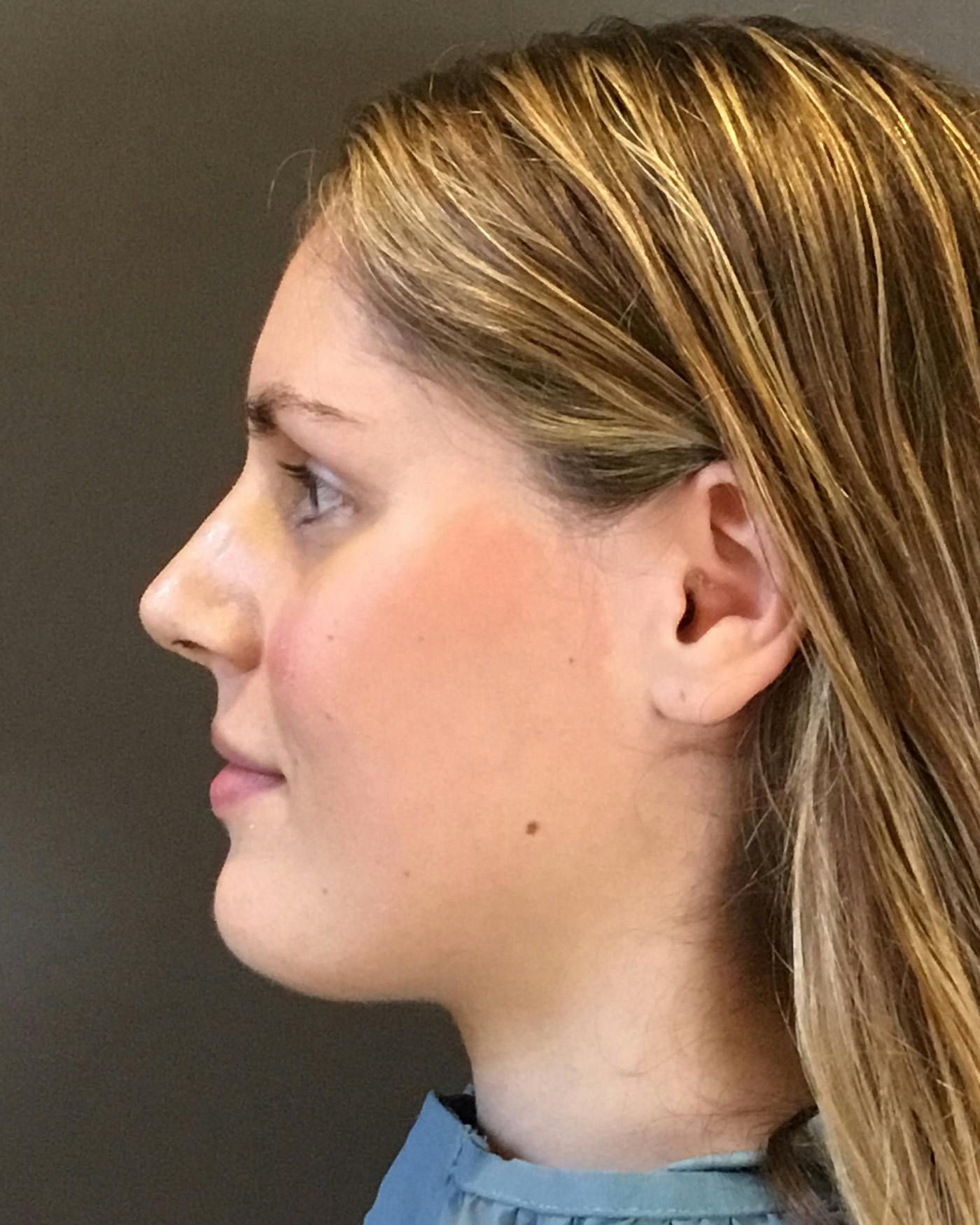 Rhinoplasty Before & After Gallery - Patient 360965 - Image 10