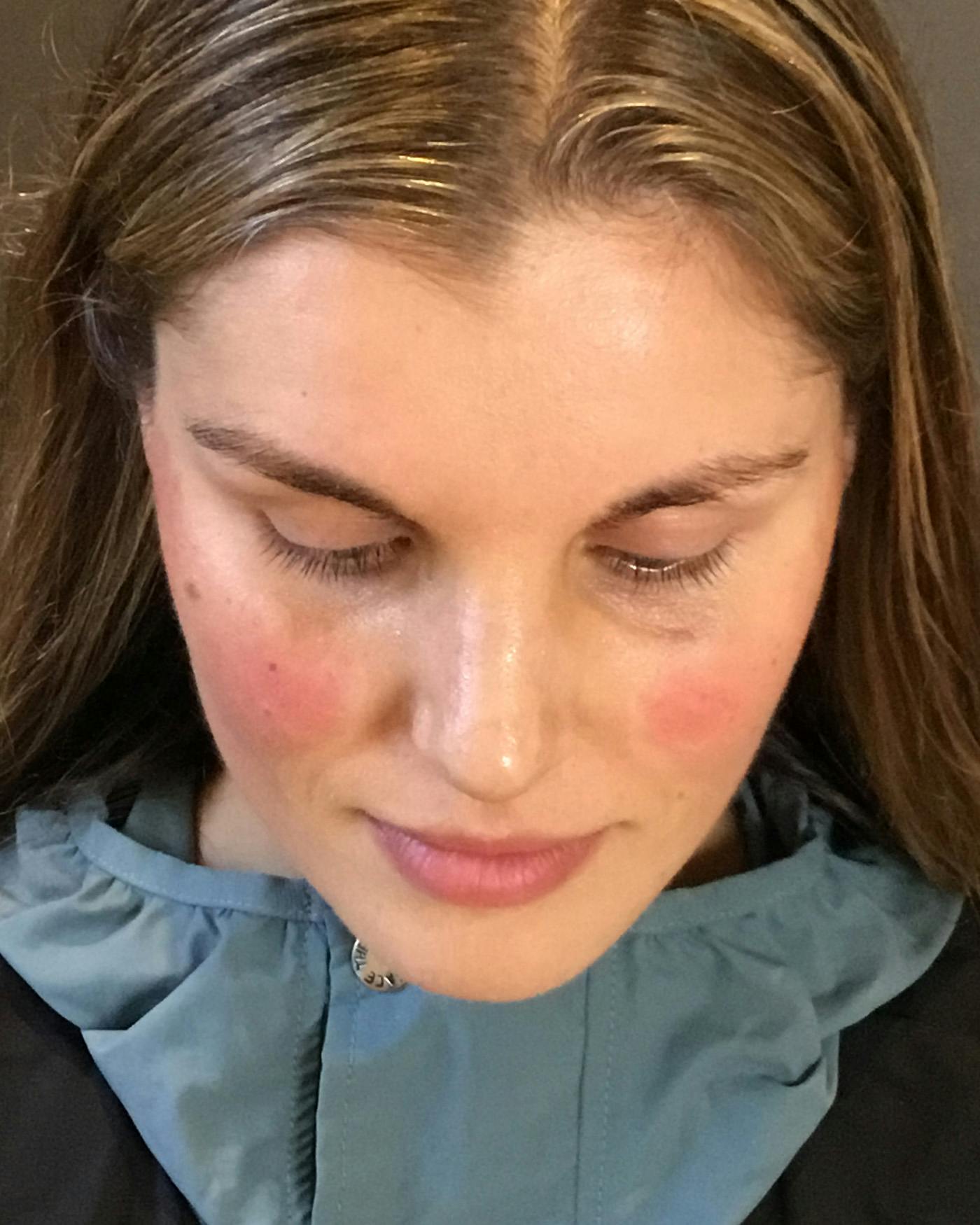 Rhinoplasty Before & After Gallery - Patient 360965 - Image 12