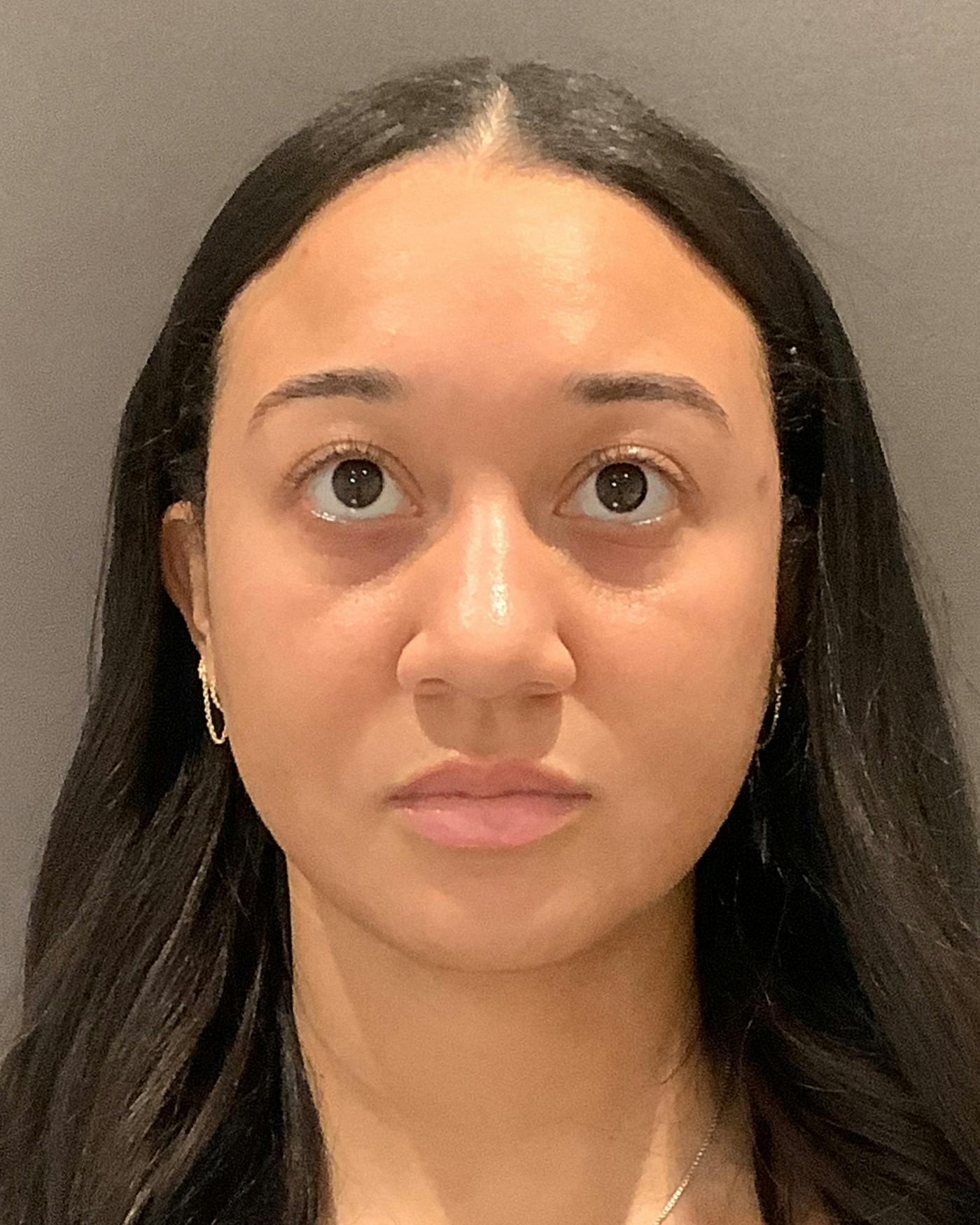 Rhinoplasty Before & After Gallery - Patient 299150 - Image 5