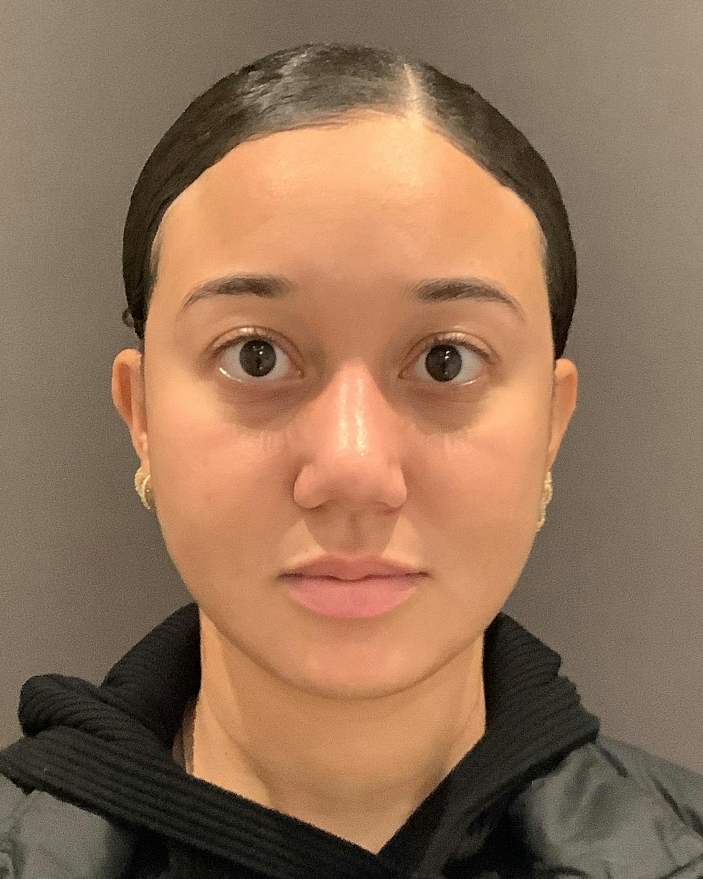 Rhinoplasty Before & After Gallery - Patient 299150 - Image 6