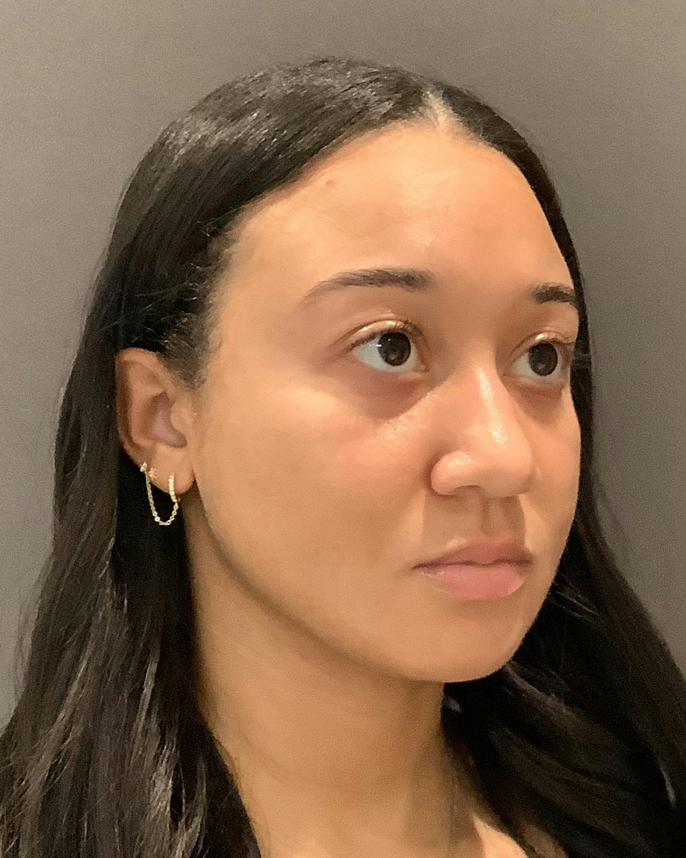 Rhinoplasty Before & After Gallery - Patient 299150 - Image 3