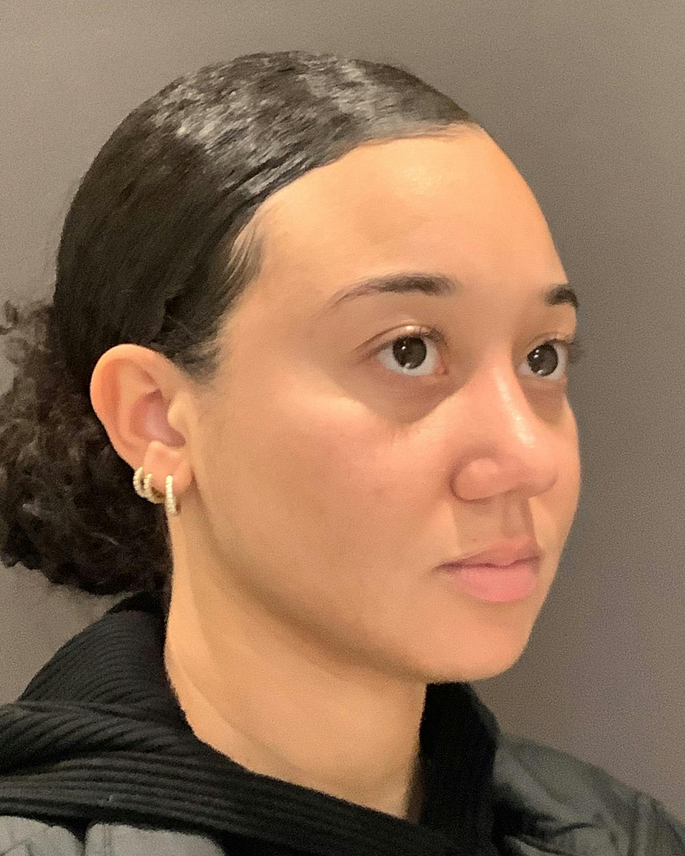 Rhinoplasty Before & After Gallery - Patient 299150 - Image 4