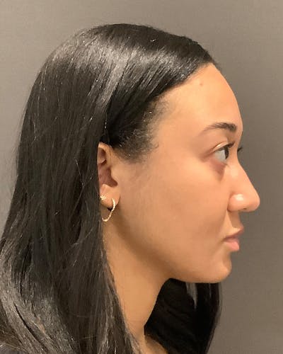 Rhinoplasty Before & After Gallery - Patient 299150 - Image 1