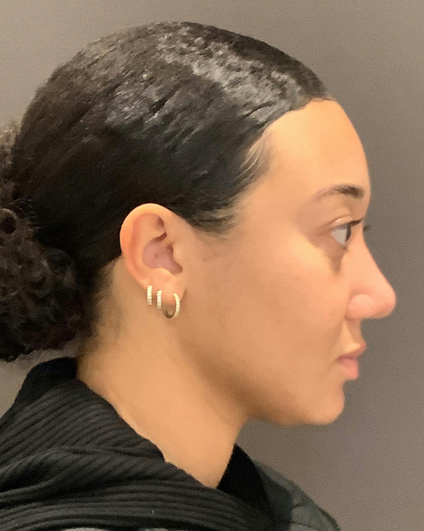 Rhinoplasty Before & After Gallery - Patient 299150 - Image 2