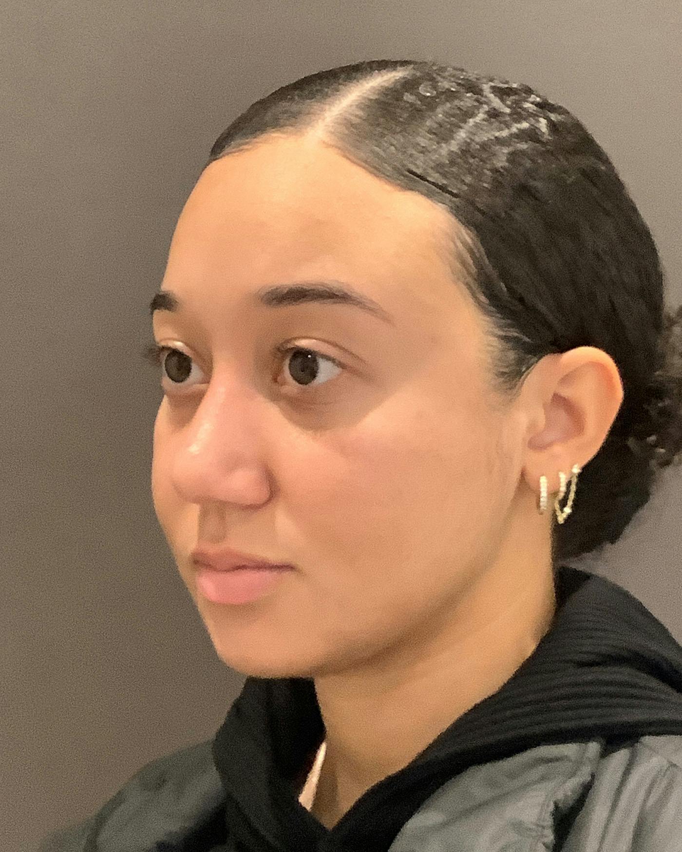 Rhinoplasty Before & After Gallery - Patient 299150 - Image 8