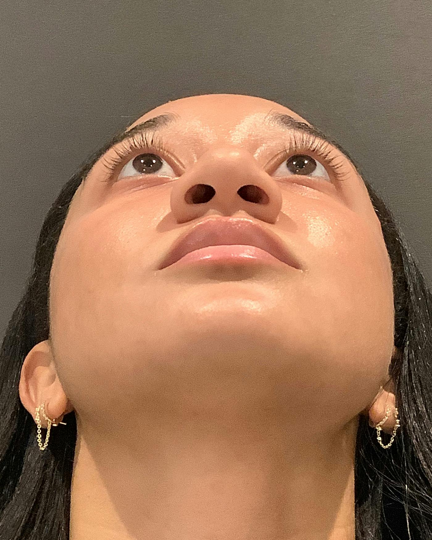 Rhinoplasty Before & After Gallery - Patient 299150 - Image 9