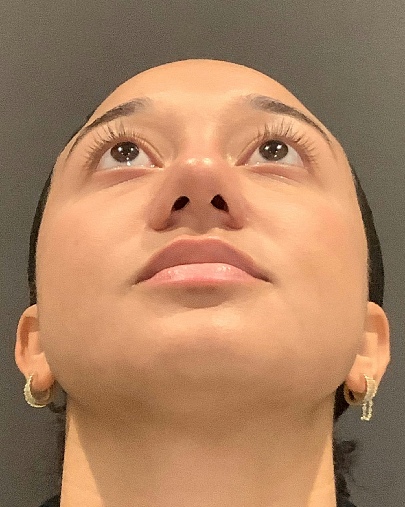 Rhinoplasty Before & After Gallery - Patient 299150 - Image 10