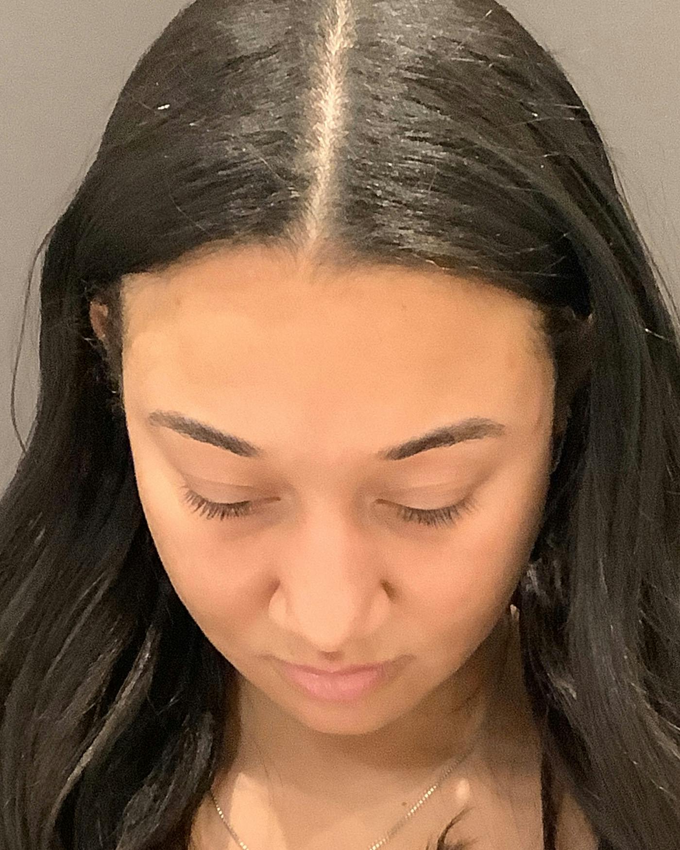 Rhinoplasty Before & After Gallery - Patient 299150 - Image 11