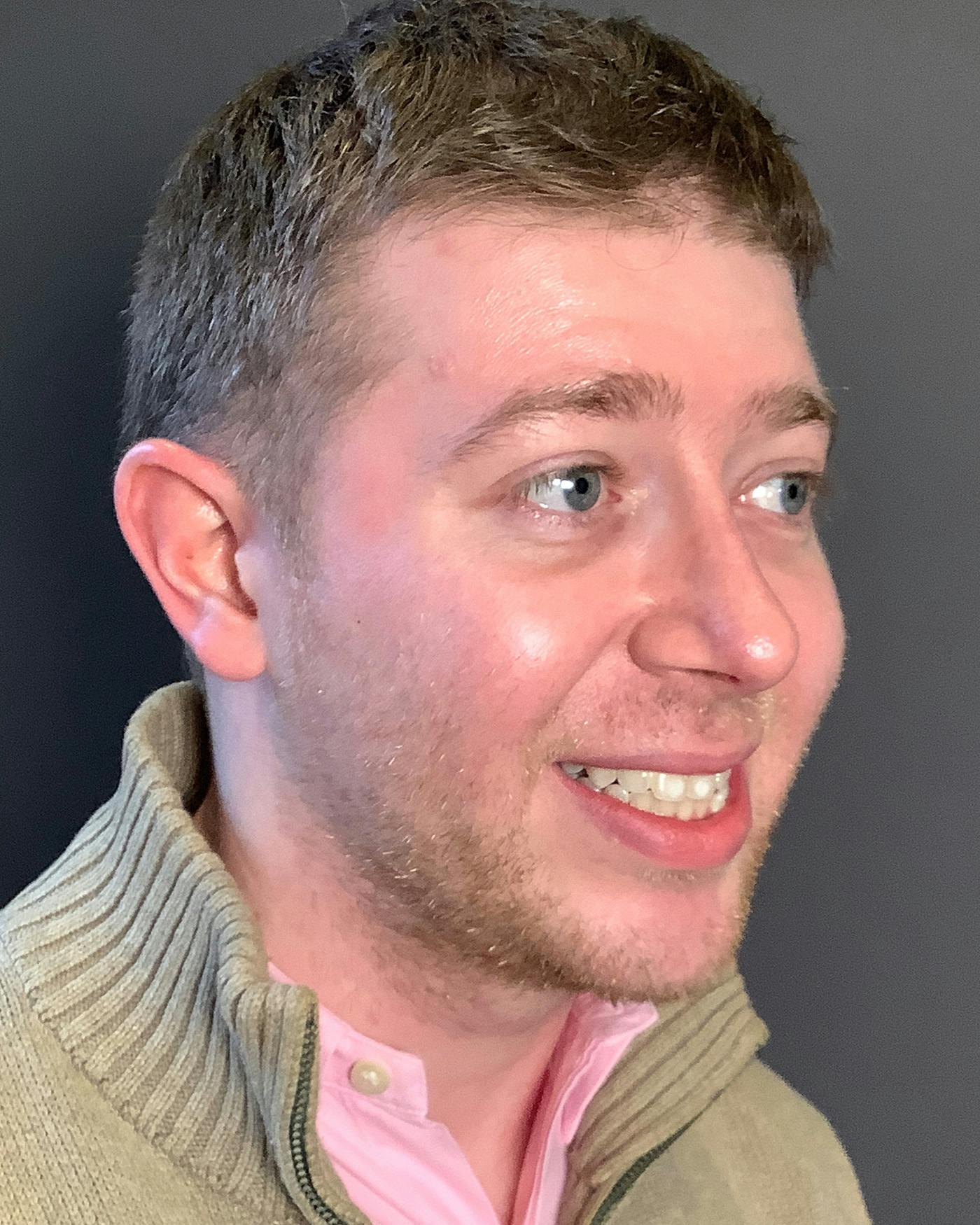 Rhinoplasty Before & After Gallery - Patient 208868 - Image 4