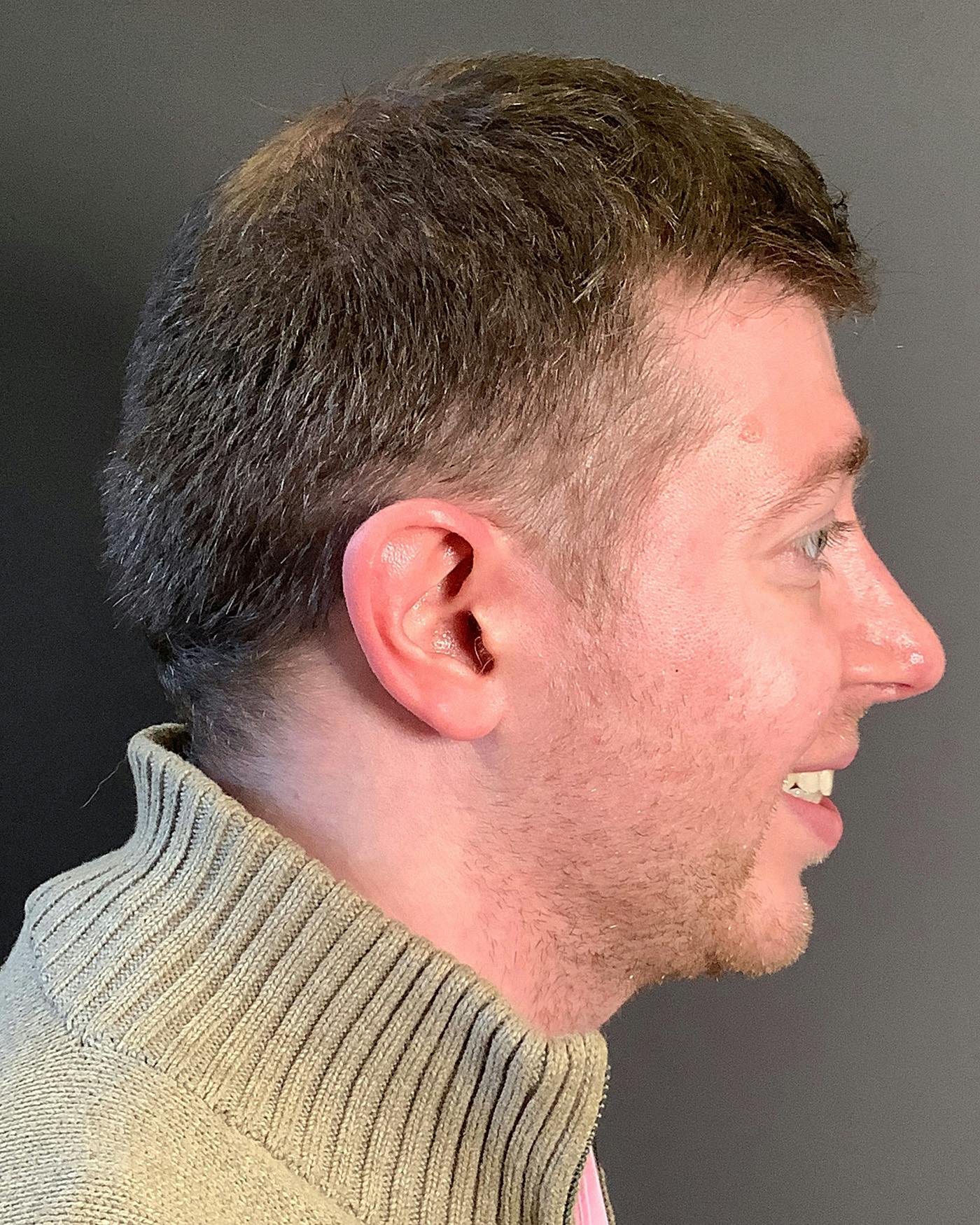 Rhinoplasty Before & After Gallery - Patient 208868 - Image 2