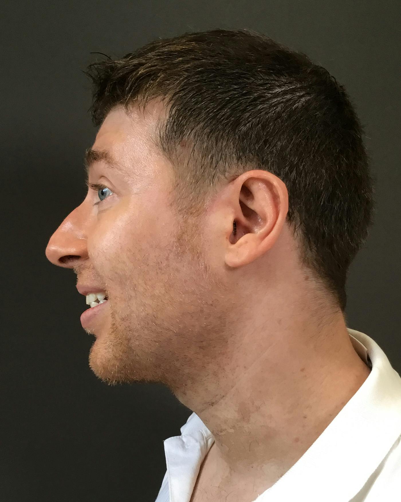 Rhinoplasty Before & After Gallery - Patient 208868 - Image 9