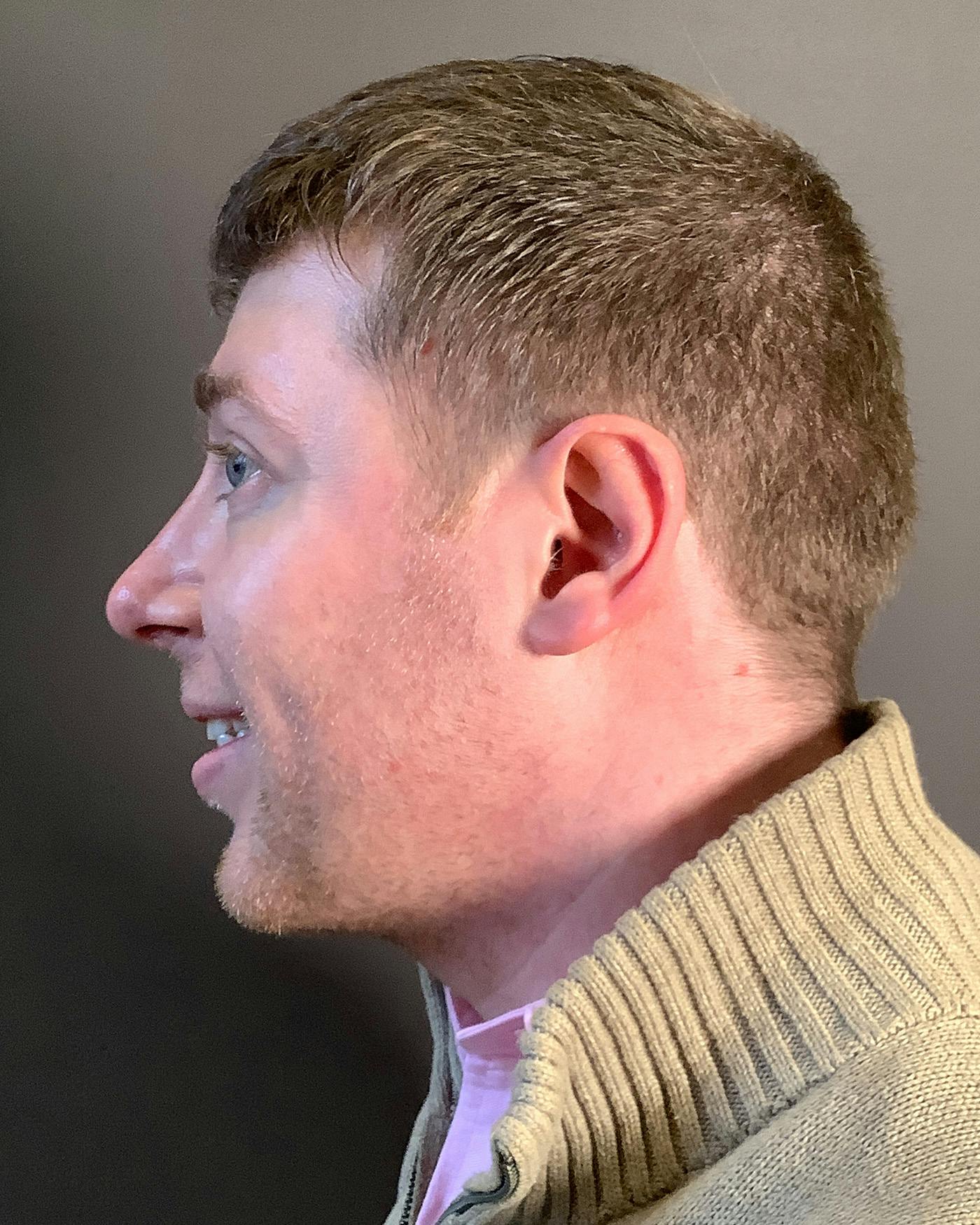 Rhinoplasty Before & After Gallery - Patient 208868 - Image 10
