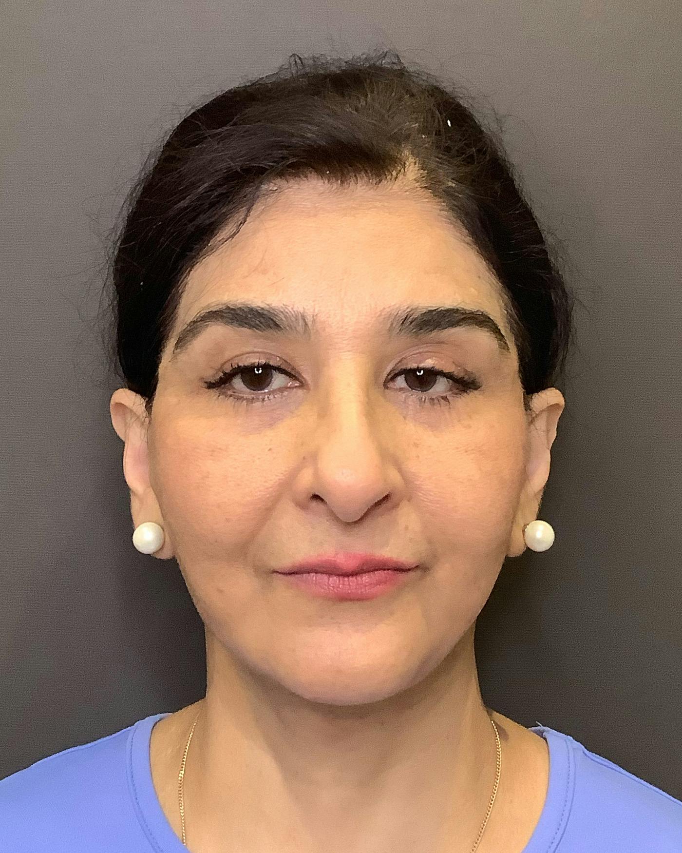 Facelifts / Necklift Before & After Gallery - Patient 190626 - Image 6