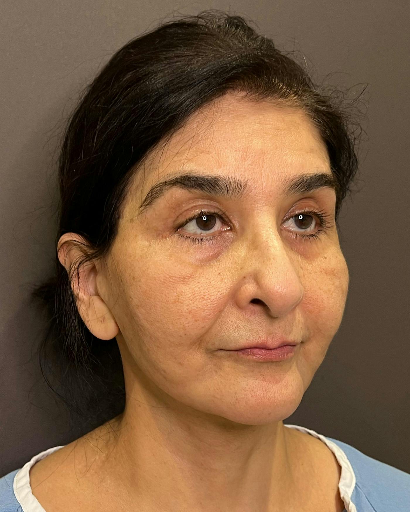 Facelifts / Necklift Before & After Gallery - Patient 190626 - Image 3