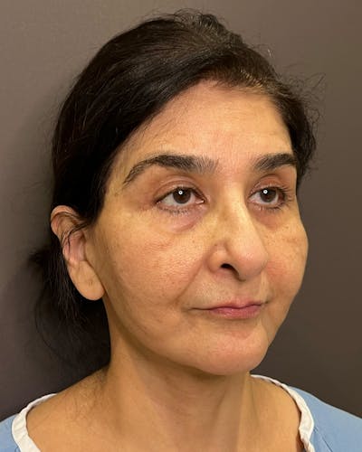 Facelifts / Necklift Before & After Gallery - Patient 190626 - Image 1