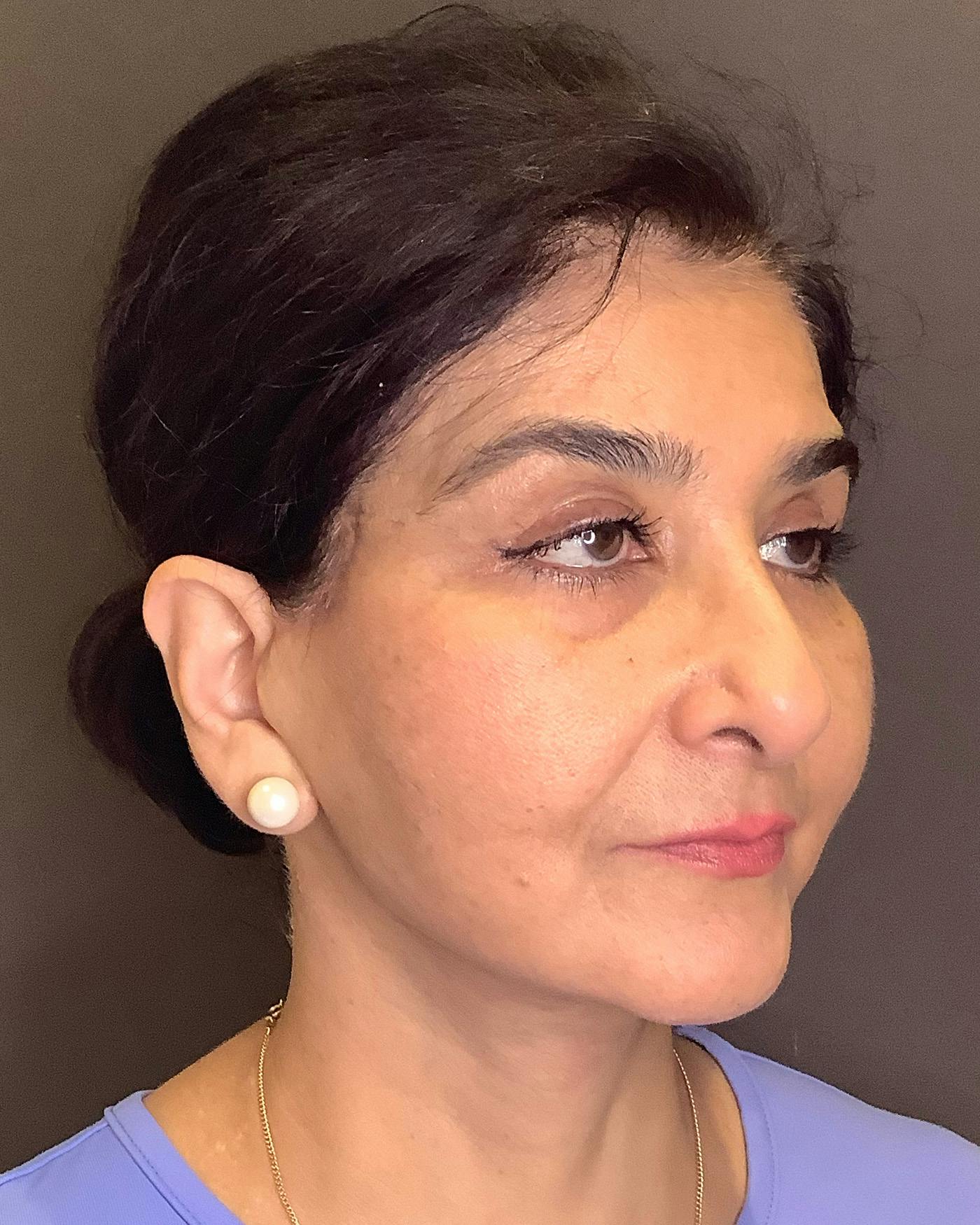 Facelifts / Necklift Before & After Gallery - Patient 190626 - Image 4