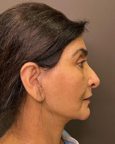 Facelifts / Necklift Before & After Gallery - Patient 190626 - Image 1
