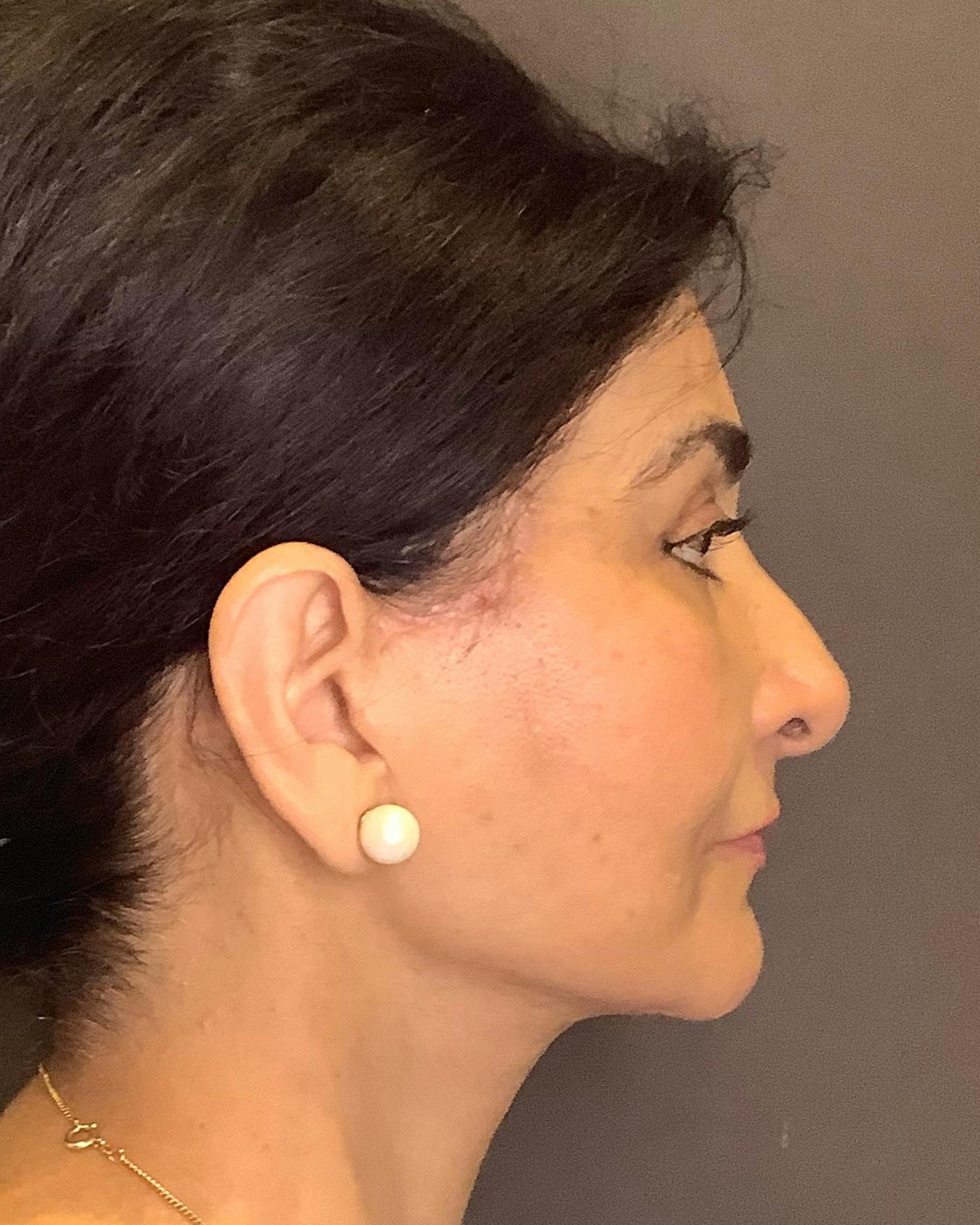 Facelifts / Necklift Before & After Gallery - Patient 190626 - Image 2