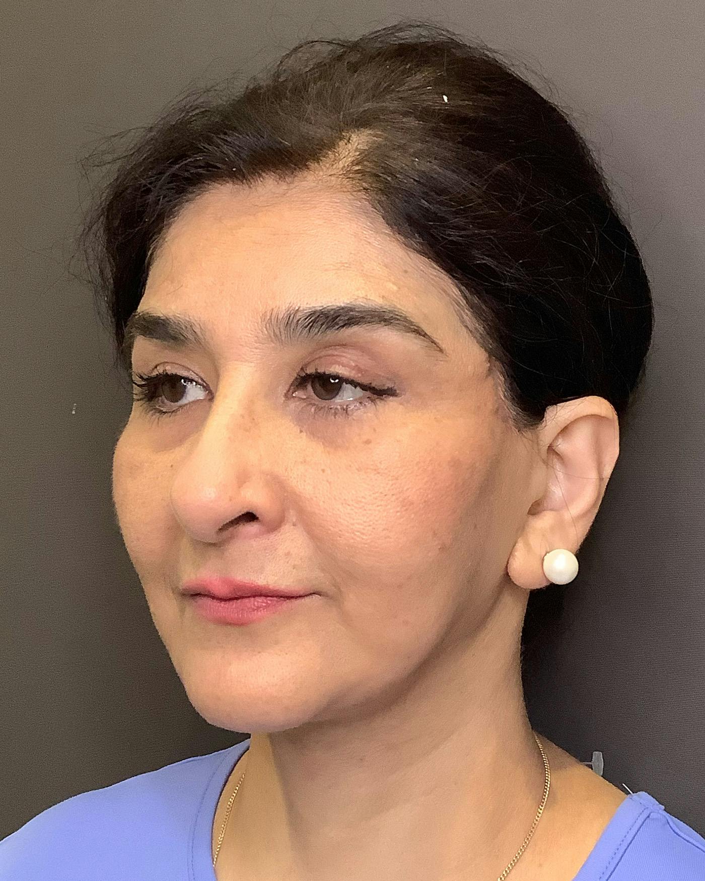 Facelifts / Necklift Before & After Gallery - Patient 190626 - Image 8