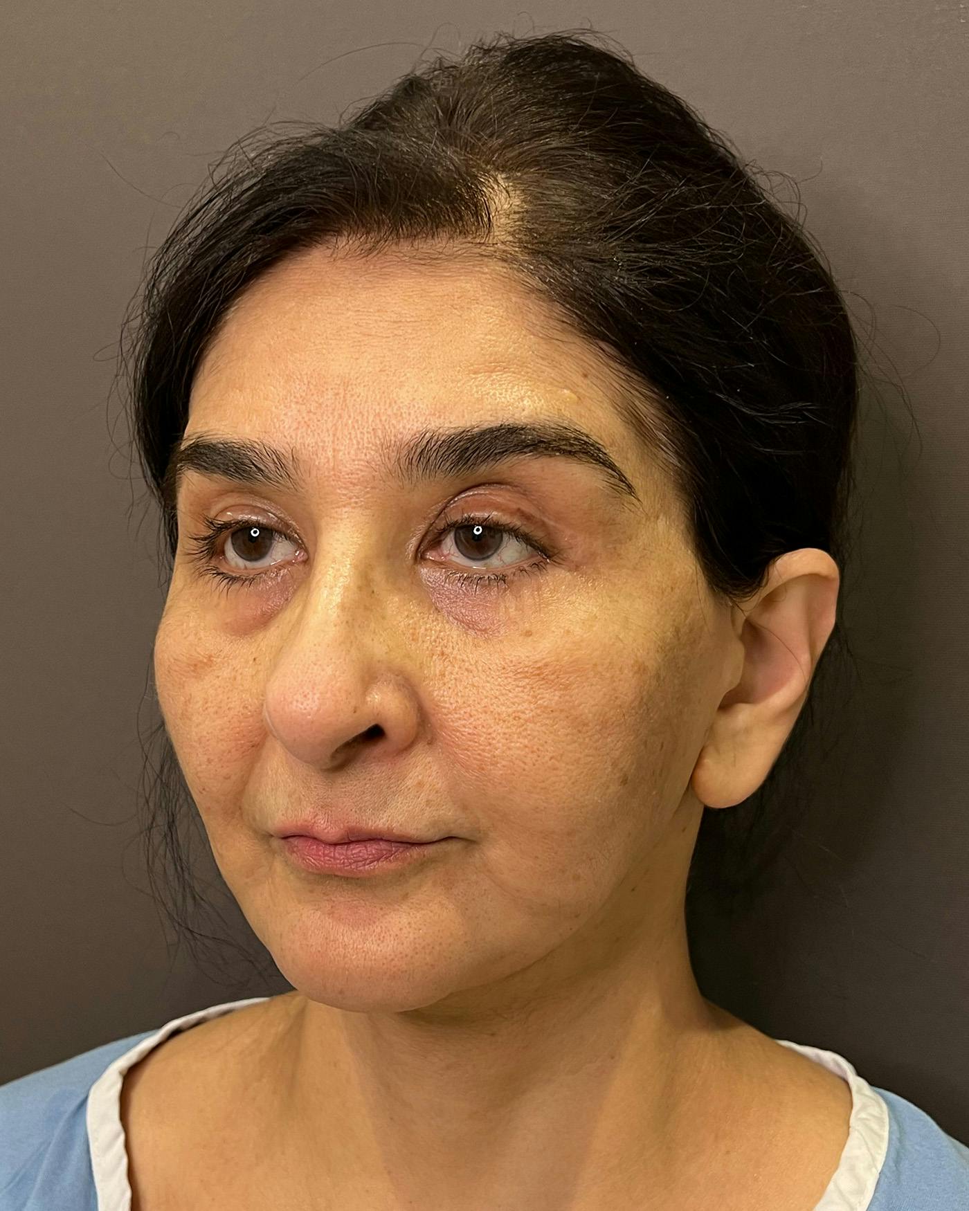 Facelifts / Necklift Before & After Gallery - Patient 190626 - Image 7