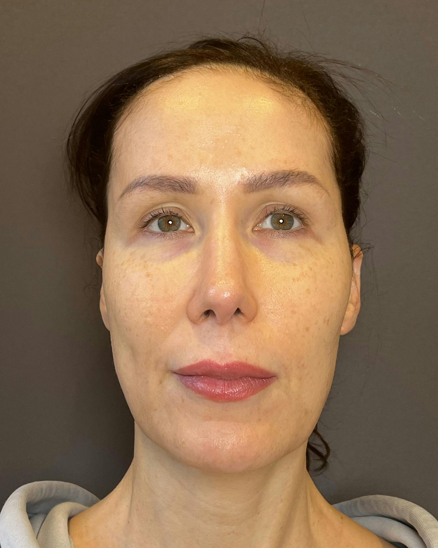 Facelifts / Necklift Before & After Gallery - Patient 159877 - Image 5