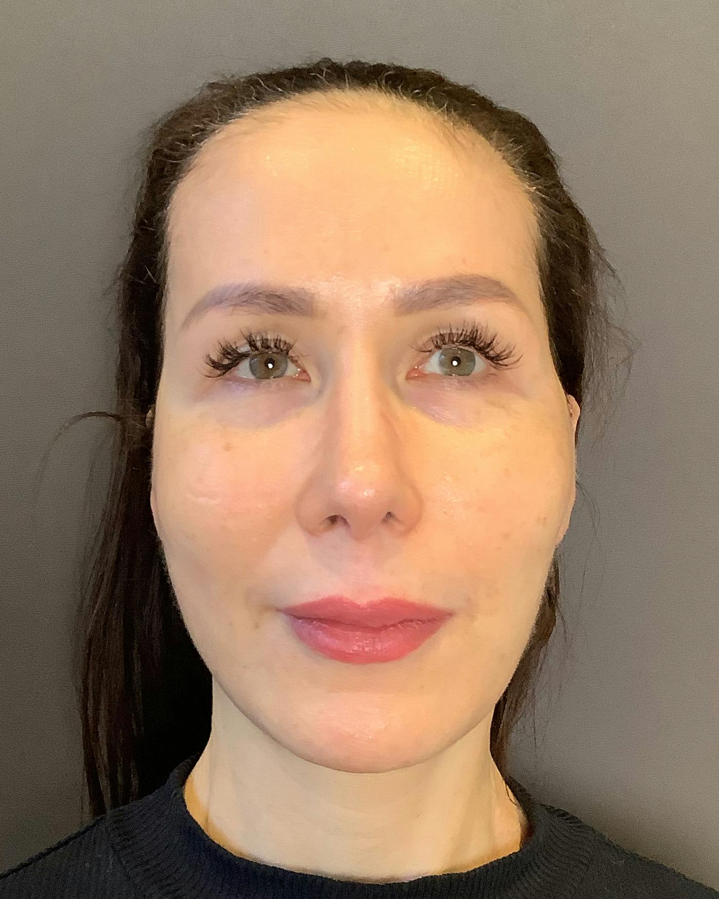Facelifts / Necklift Before & After Gallery - Patient 159877 - Image 6