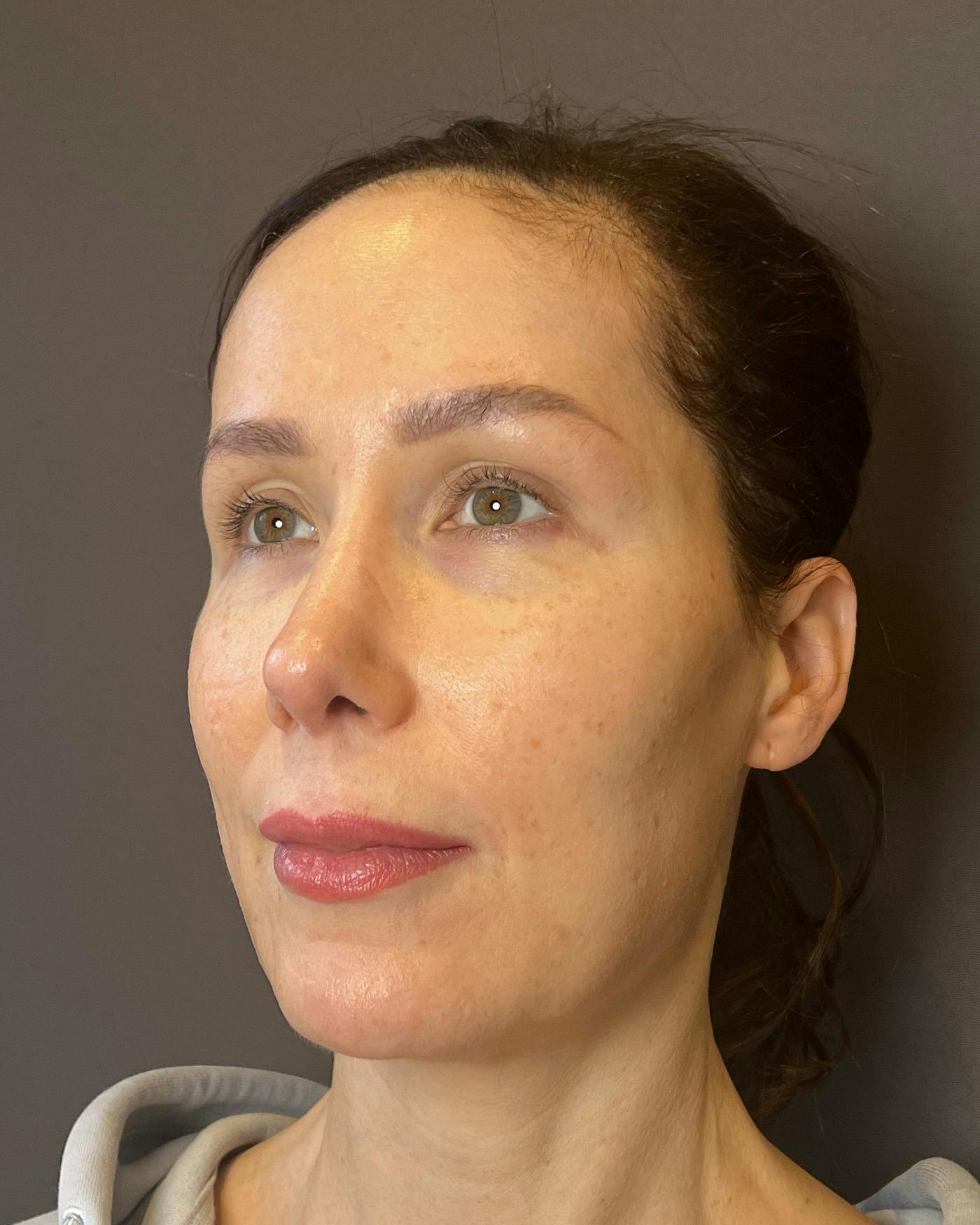 Facelifts / Necklift Before & After Gallery - Patient 159877 - Image 3