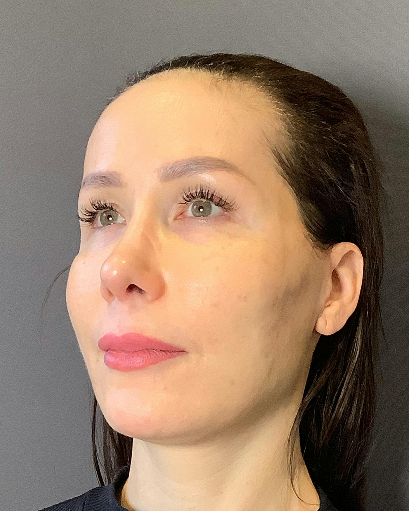 Facelifts / Necklift Before & After Gallery - Patient 159877 - Image 4
