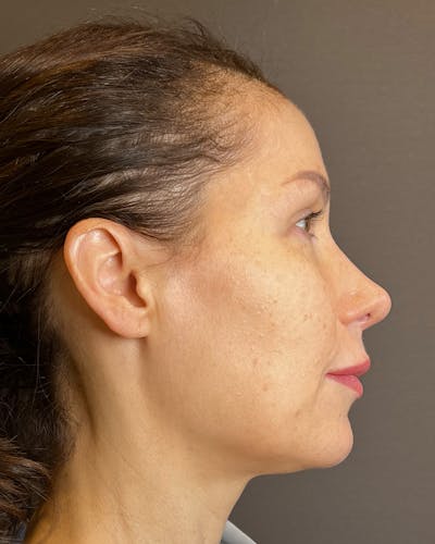 Facelifts / Necklift Before & After Gallery - Patient 159877 - Image 1