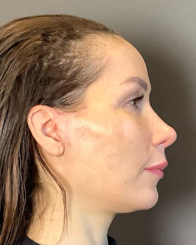 Facelifts / Necklift Before & After Gallery - Patient 159877 - Image 2
