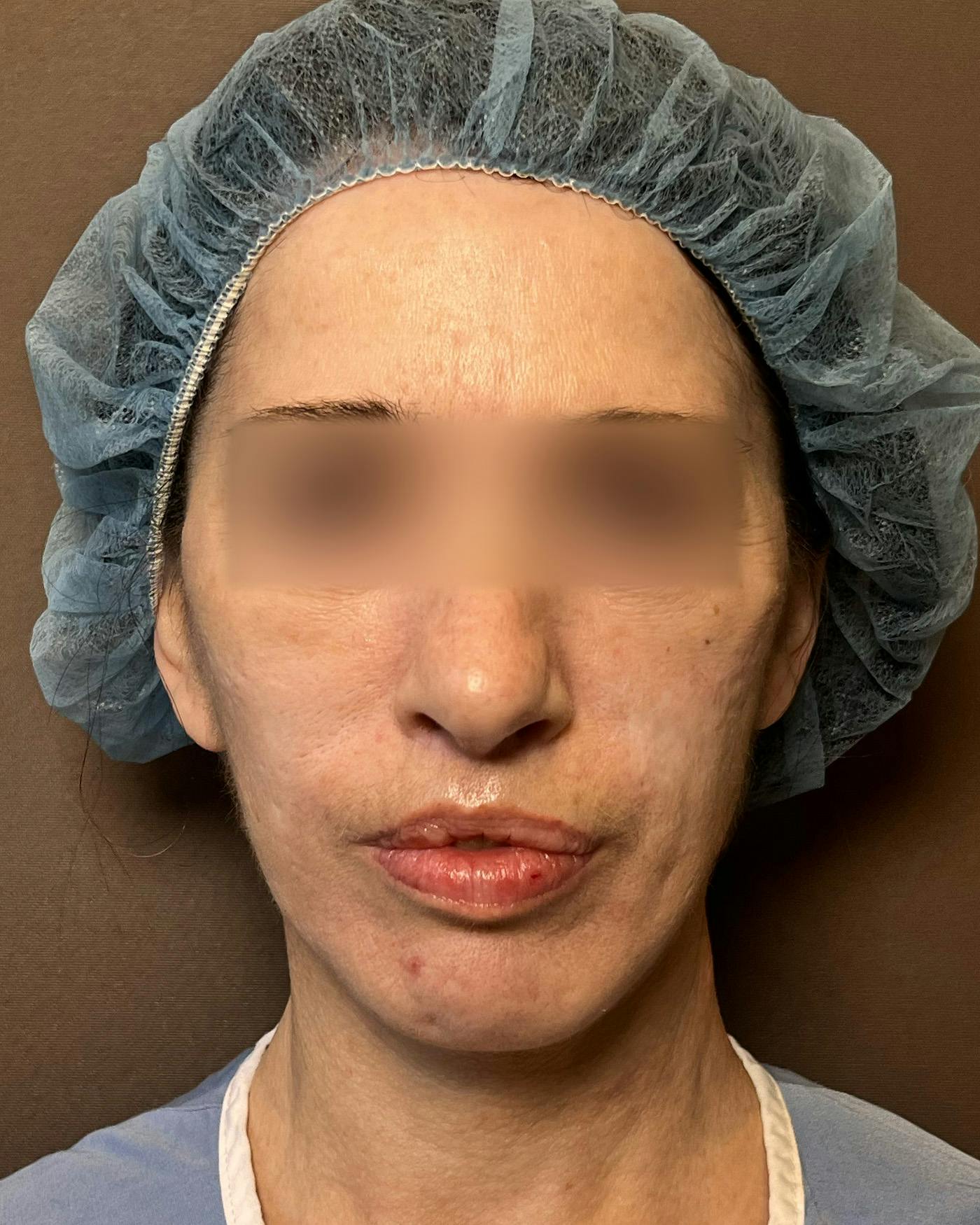 Facelifts / Necklift Before & After Gallery - Patient 842301 - Image 6