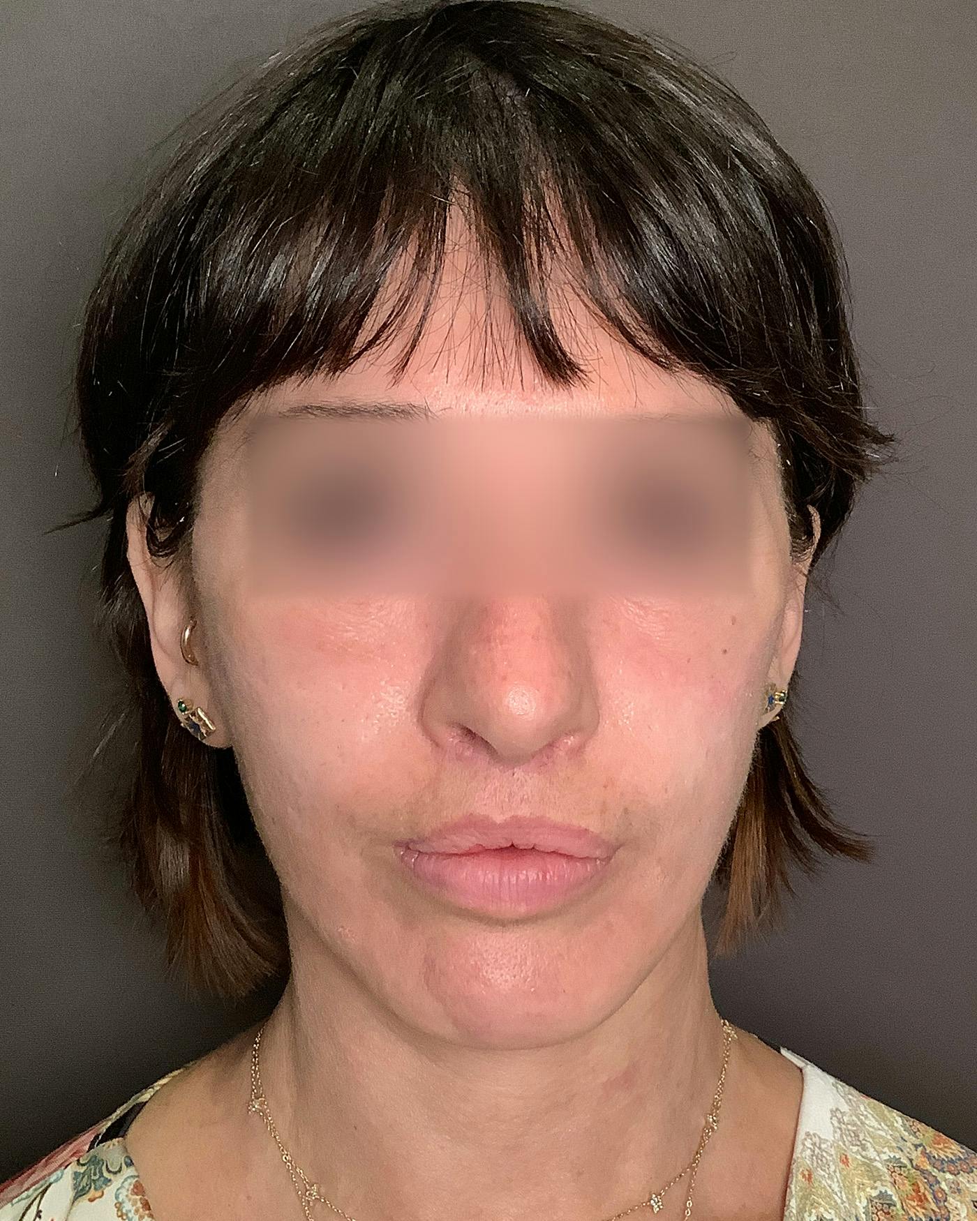 Facelifts / Necklift Before & After Gallery - Patient 842301 - Image 5