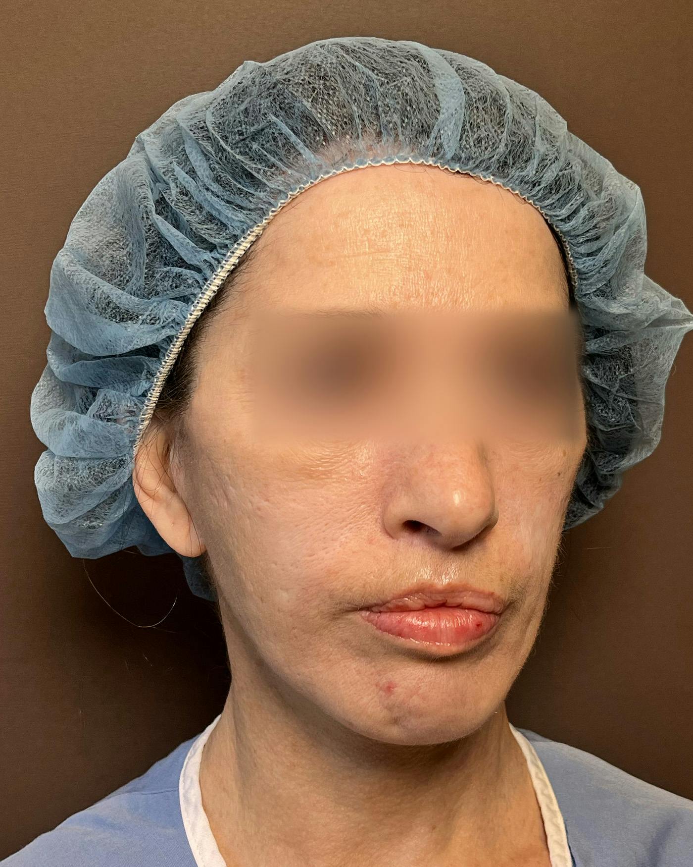 Facelifts / Necklift Before & After Gallery - Patient 842301 - Image 3