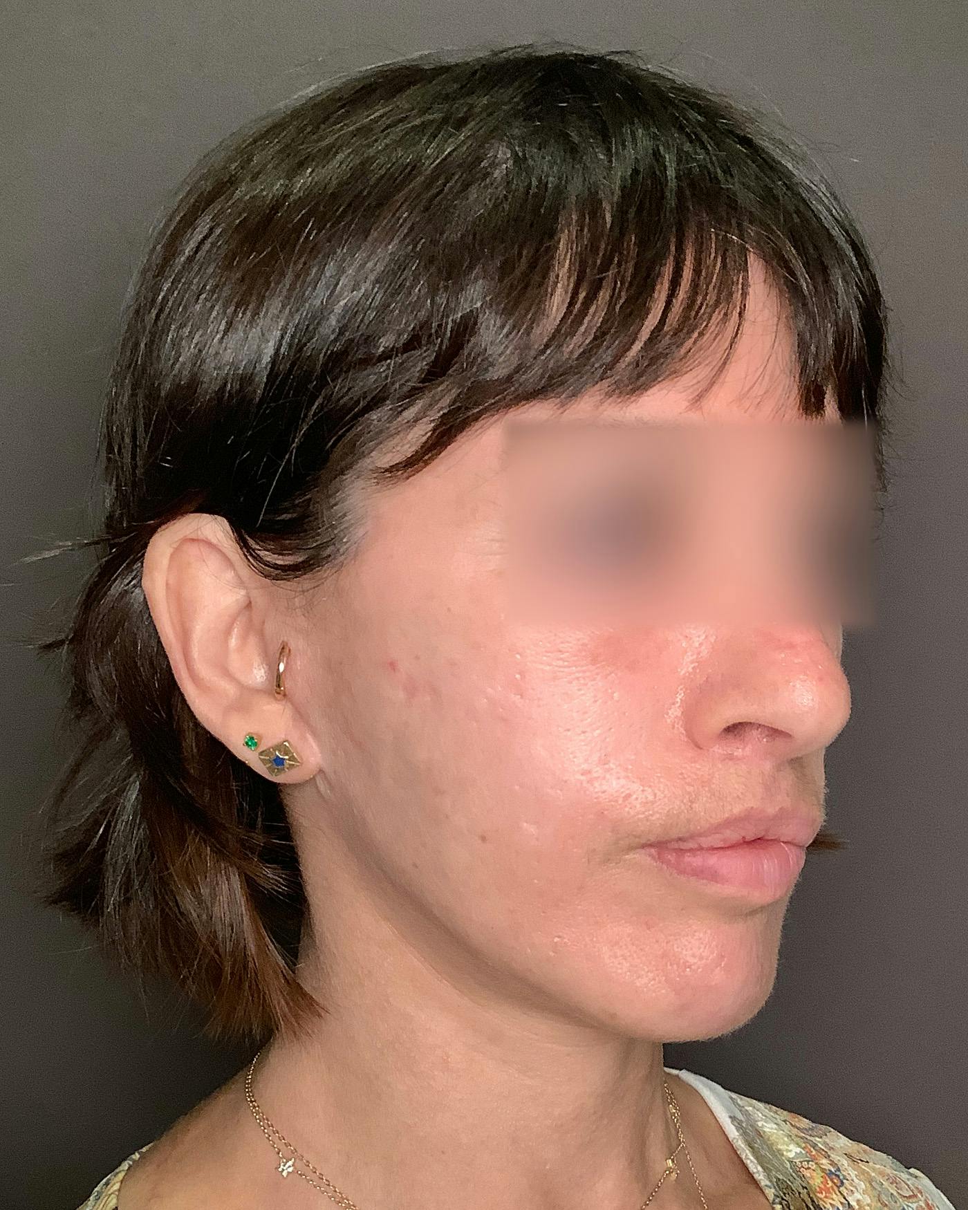 Facelifts / Necklift Before & After Gallery - Patient 842301 - Image 4