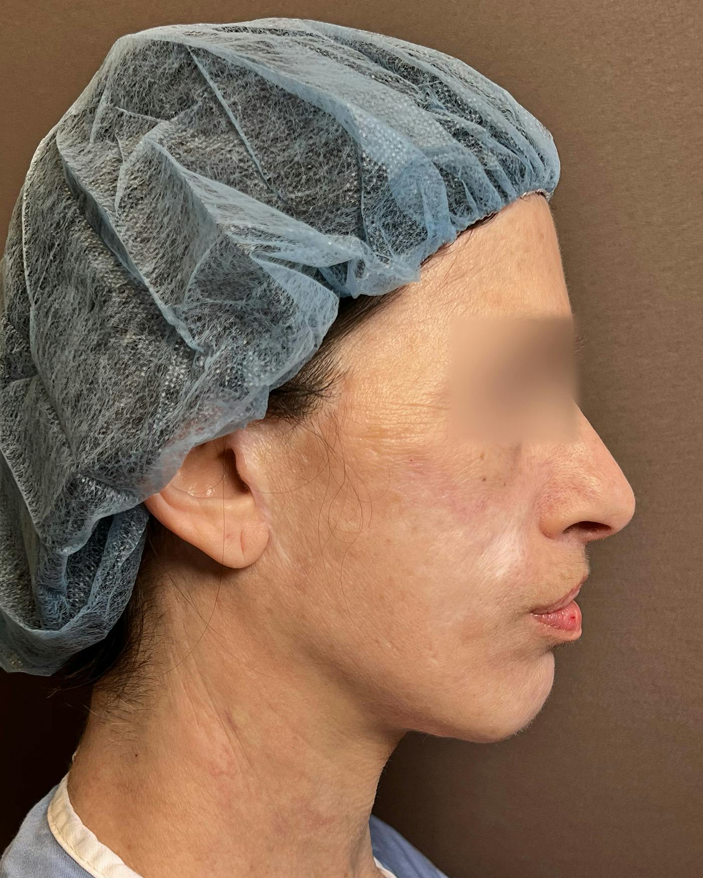 Facelifts / Necklift Before & After Gallery - Patient 842301 - Image 1