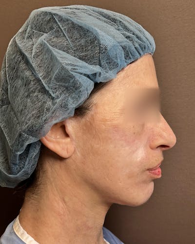 Facelifts / Necklift Before & After Gallery - Patient 842301 - Image 1
