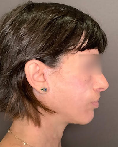 Facelifts / Necklift Before & After Gallery - Patient 842301 - Image 2