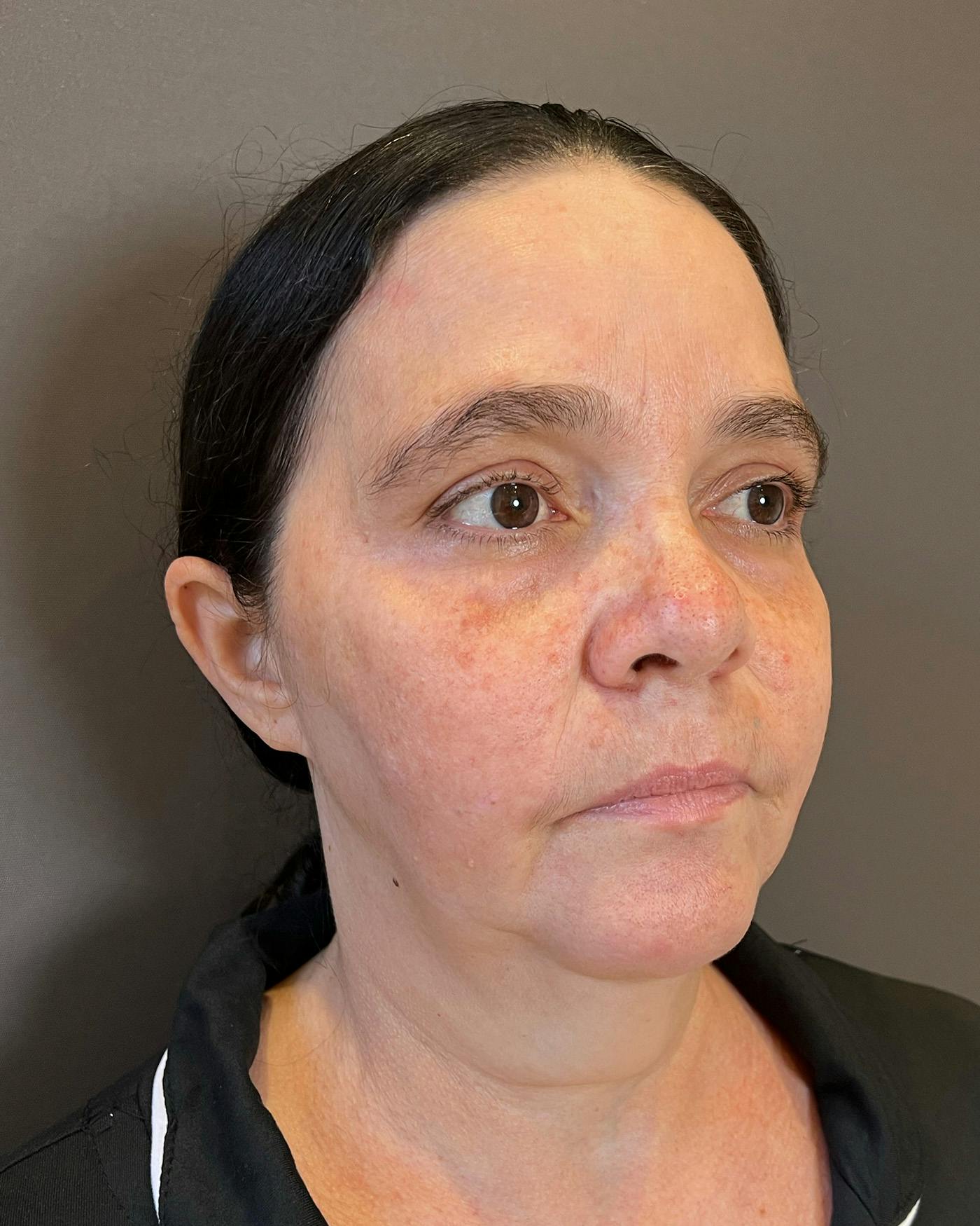 Facelifts / Necklift Before & After Gallery - Patient 415351 - Image 3